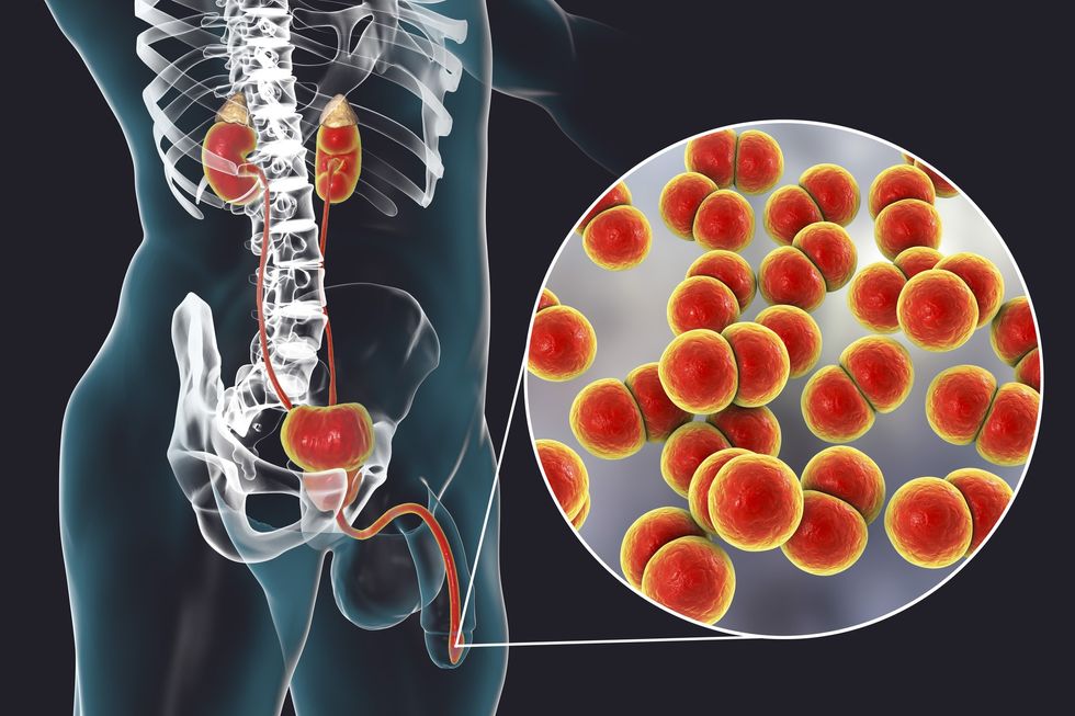 Illustration of gonorrhoea infection in male