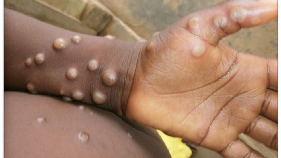 Monkeypox quarantine introduced in Belgium