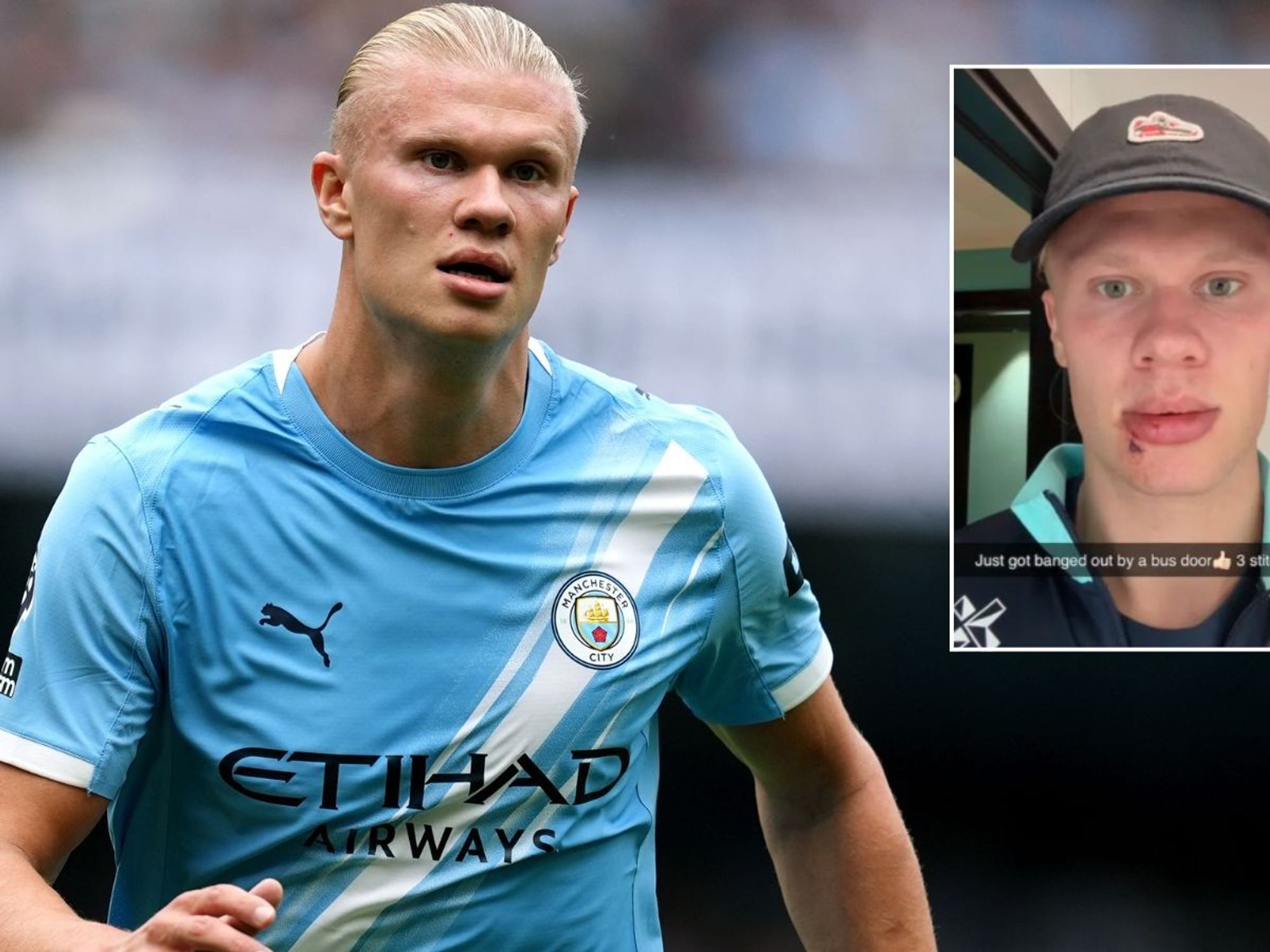 Erling Haaland shows off facial injury after freak incident involving Norway team bus