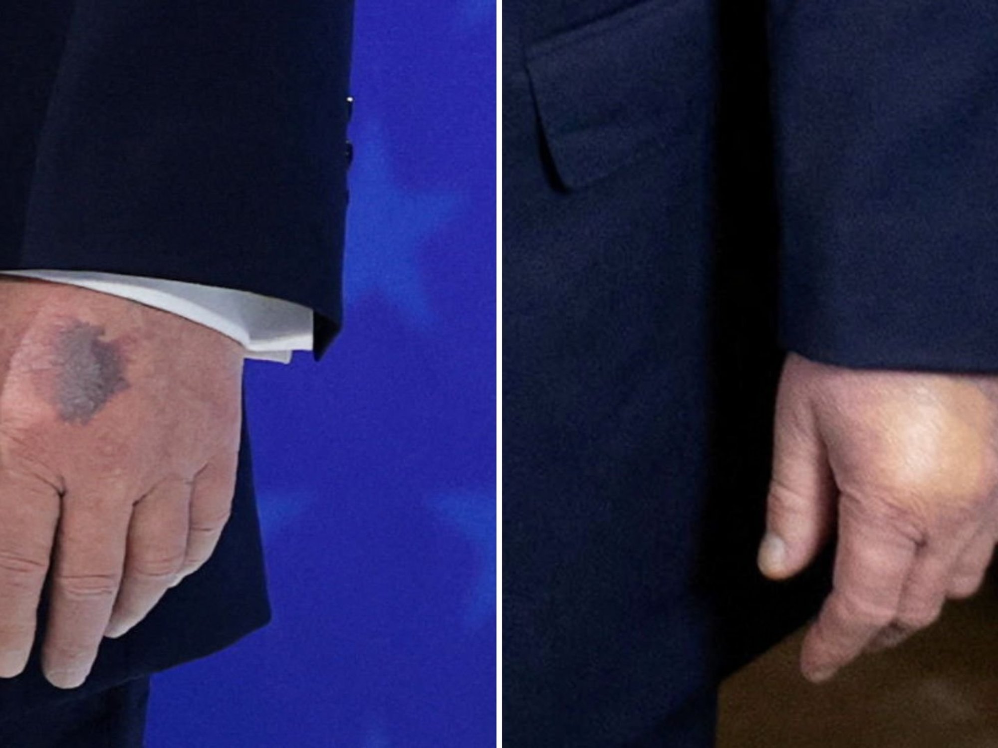 Donald Trump opens up on mysterious bruising after suffering injury on Davos stage