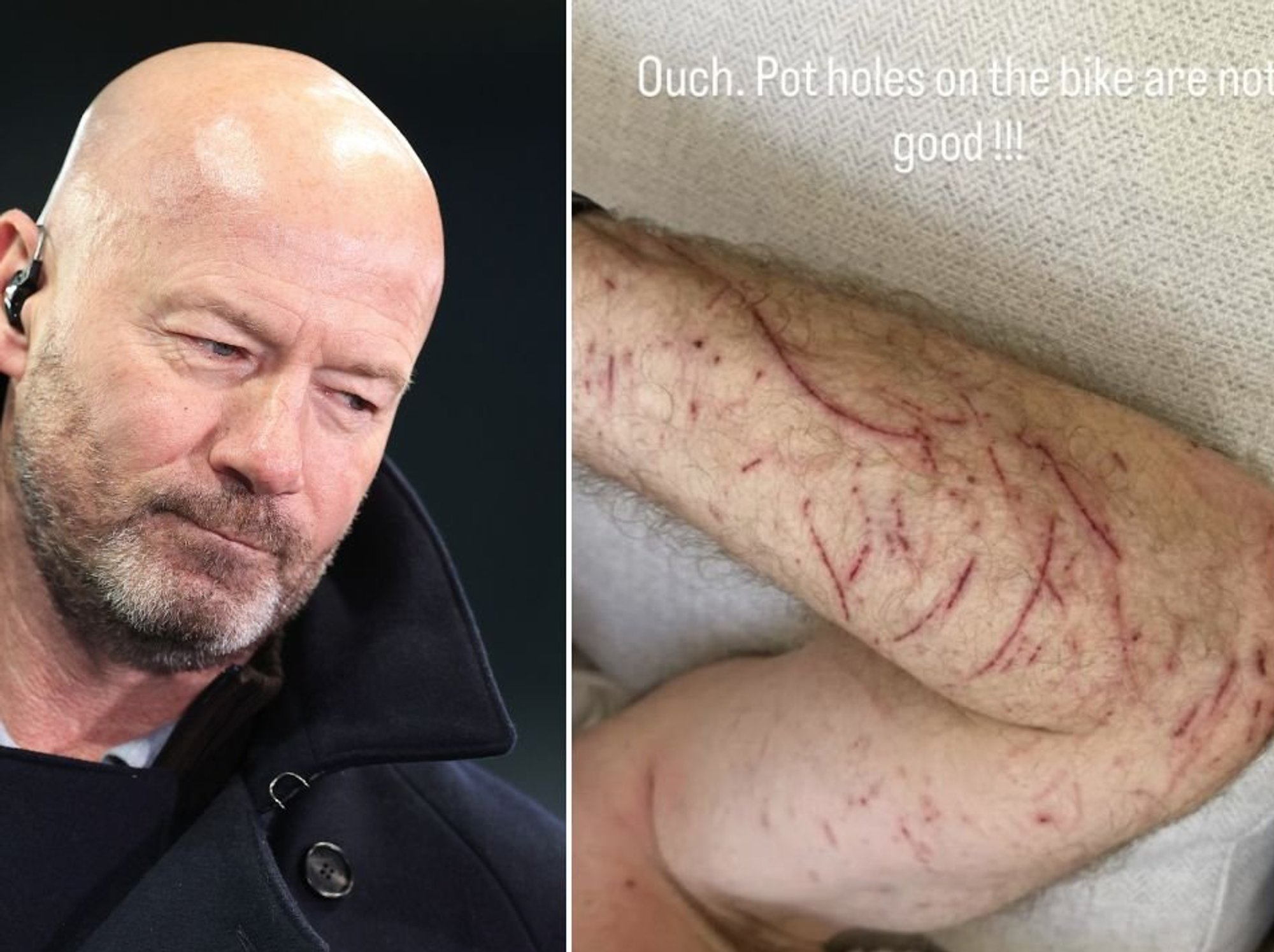 BBC pundit Alan Shearer suffers gruesome injuries after bike hits pothole in major crash