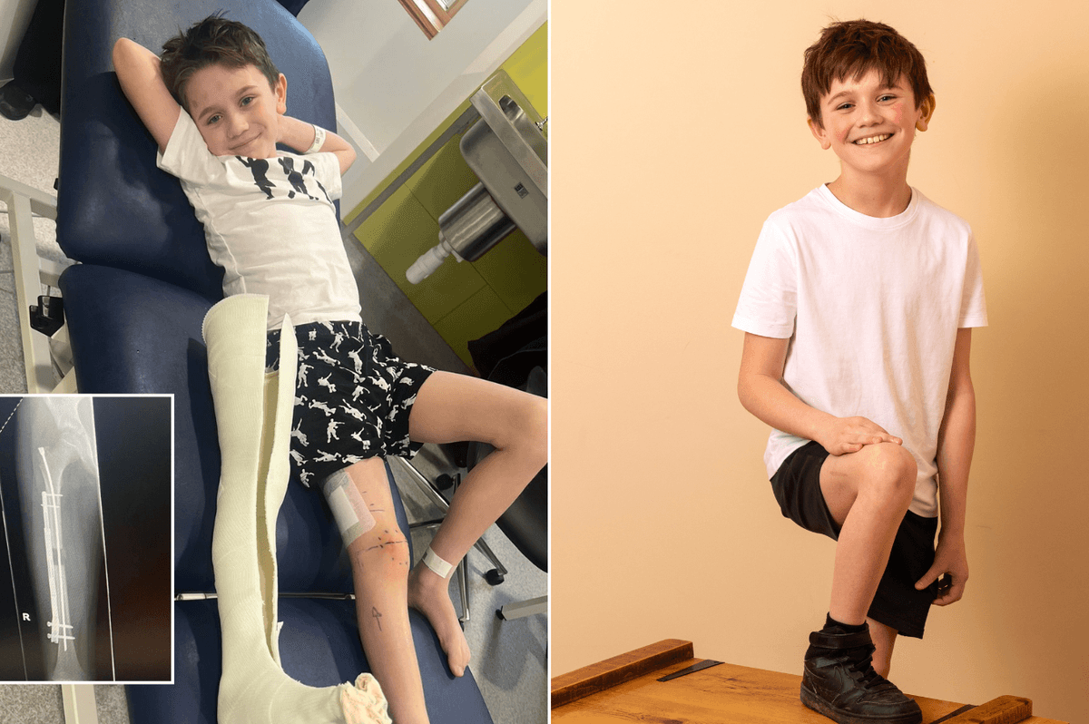 Schoolboy, 9, makes history as his legs are made longer in groundbreaking new surgery