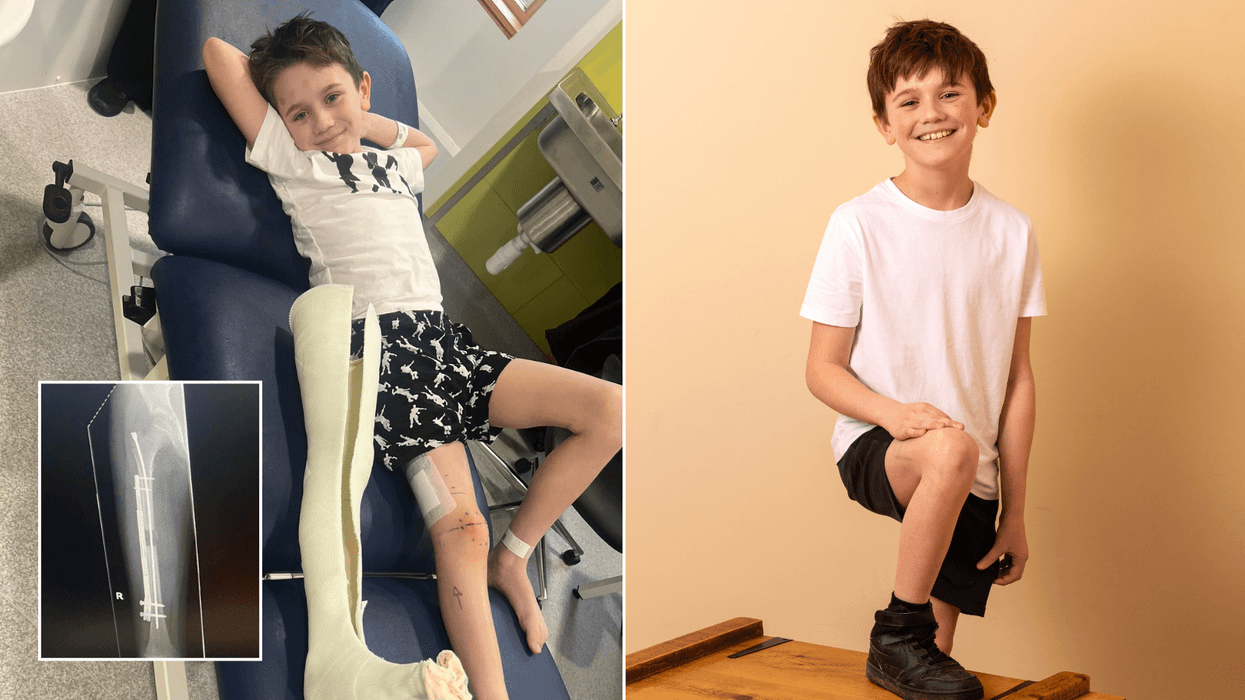 Schoolboy, 9, makes history as his legs are made longer in groundbreaking new surgery