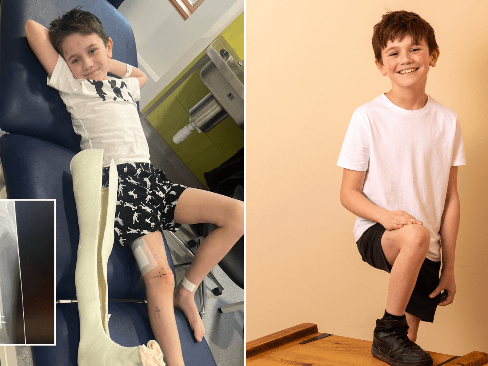 Schoolboy, 9, has legs made longer in groundbreaking new surgery - 'He was up walking the next day!'