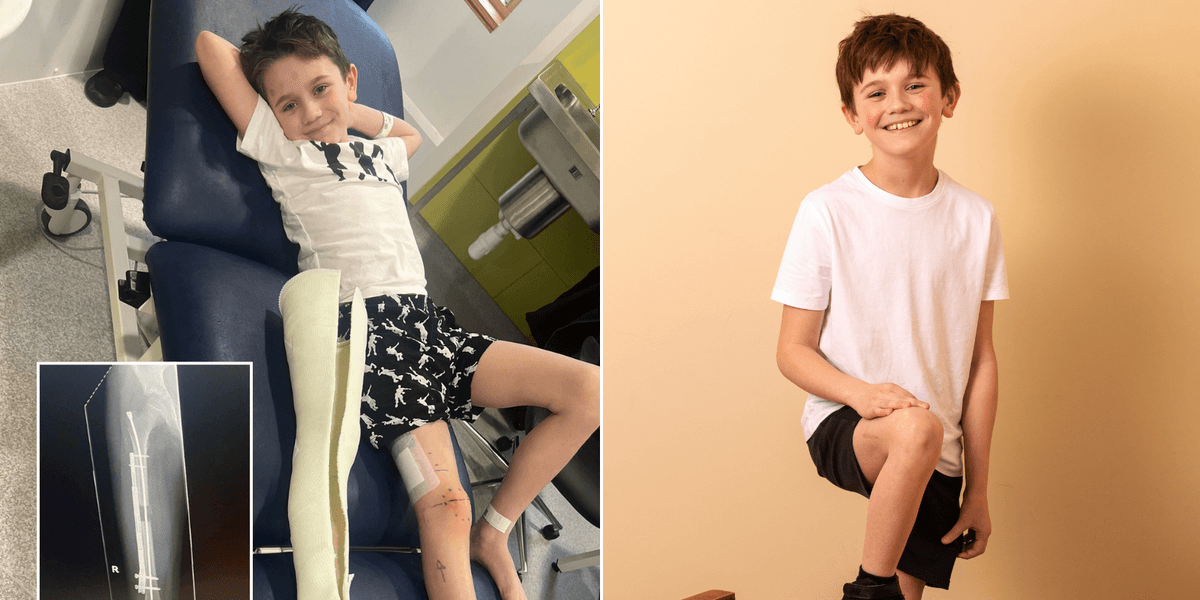Northamptonshire schoolboy Alfie Phillips, 9, has legs made longer in groundbreaking new surgery Northamptonshire schoolboy Alfie Phillips, 9, has legs made longer in groundbreaking new surgery