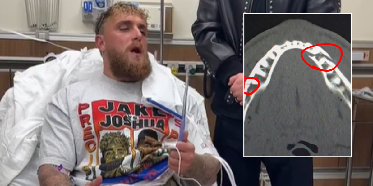 Jake Paul shares video from hospital bed following Anthony Joshua bout as x-rays reveal double broken jaw Jake Paul shares video from hospital bed following Anthony Joshua bout as x-rays reveal double broken jaw