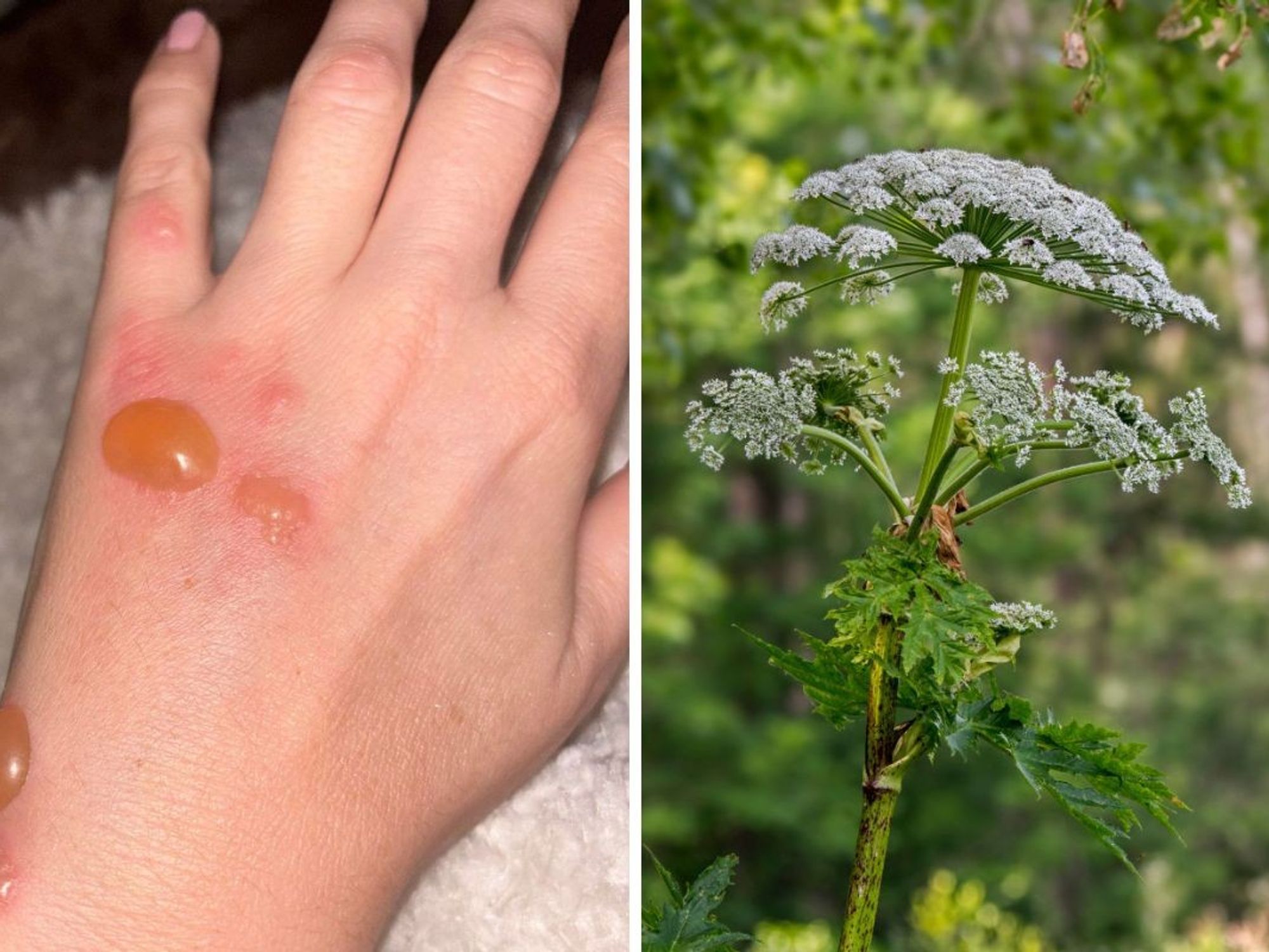 Kelly Sherry's burns / Giant hogweed