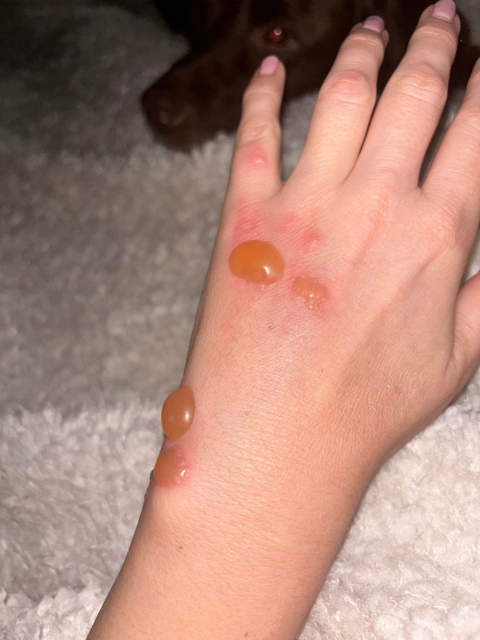 Kelly Sherry's burns