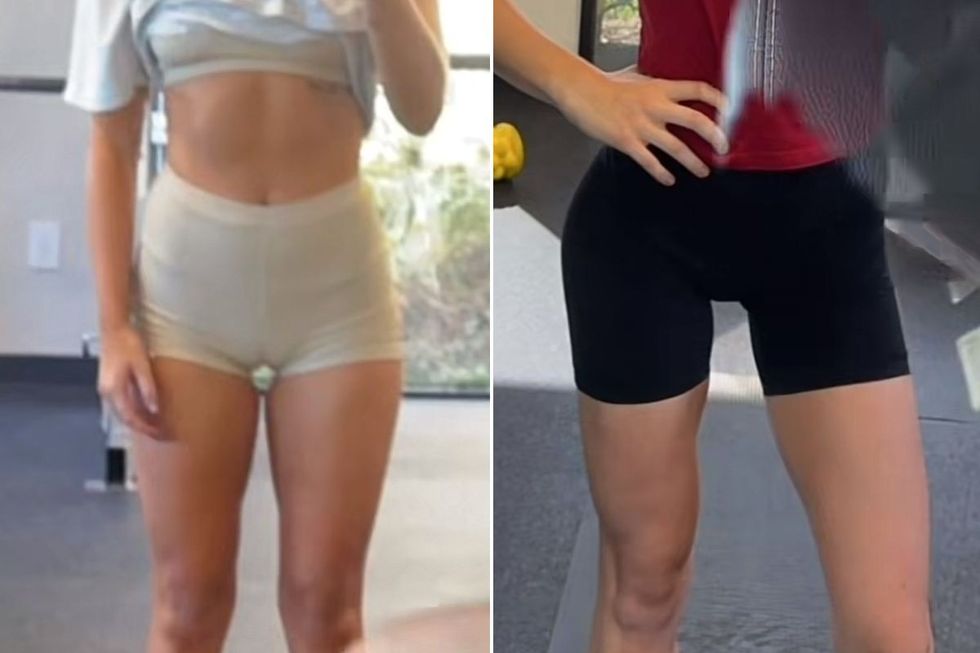 Kelsey's legs before and after