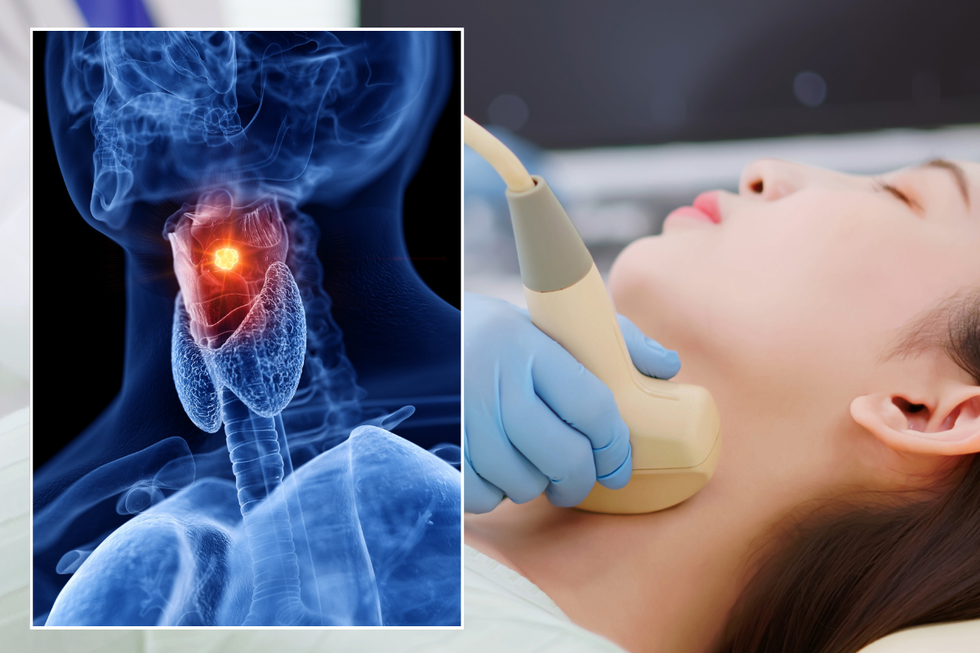 Laryngeal cancer illustration; neck ultrasound