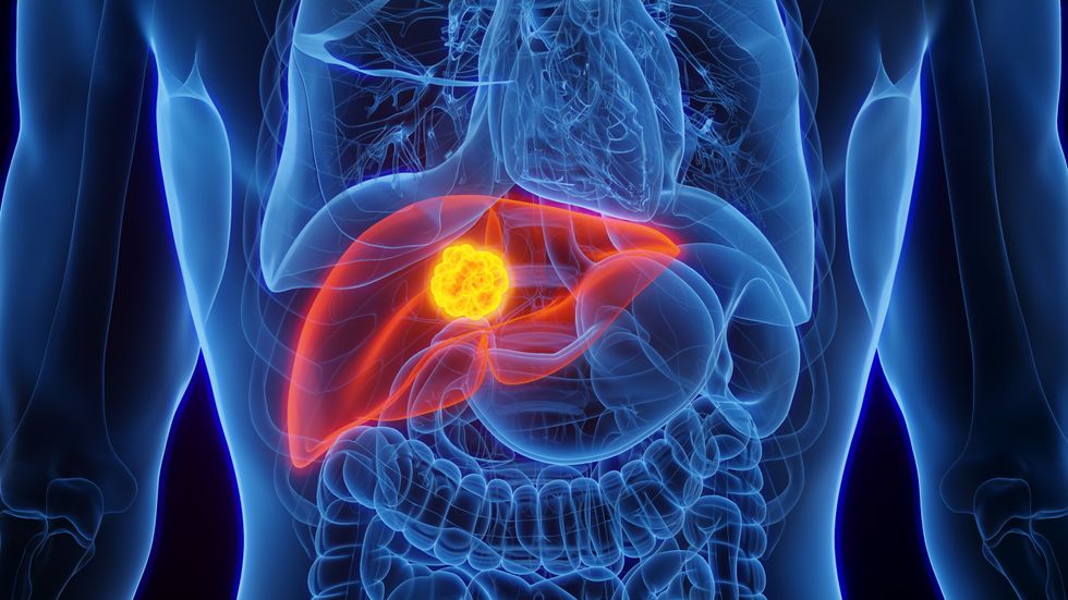 Liver cancer illustration