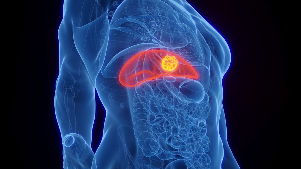 LIVER CANCER ILLUSTRATION