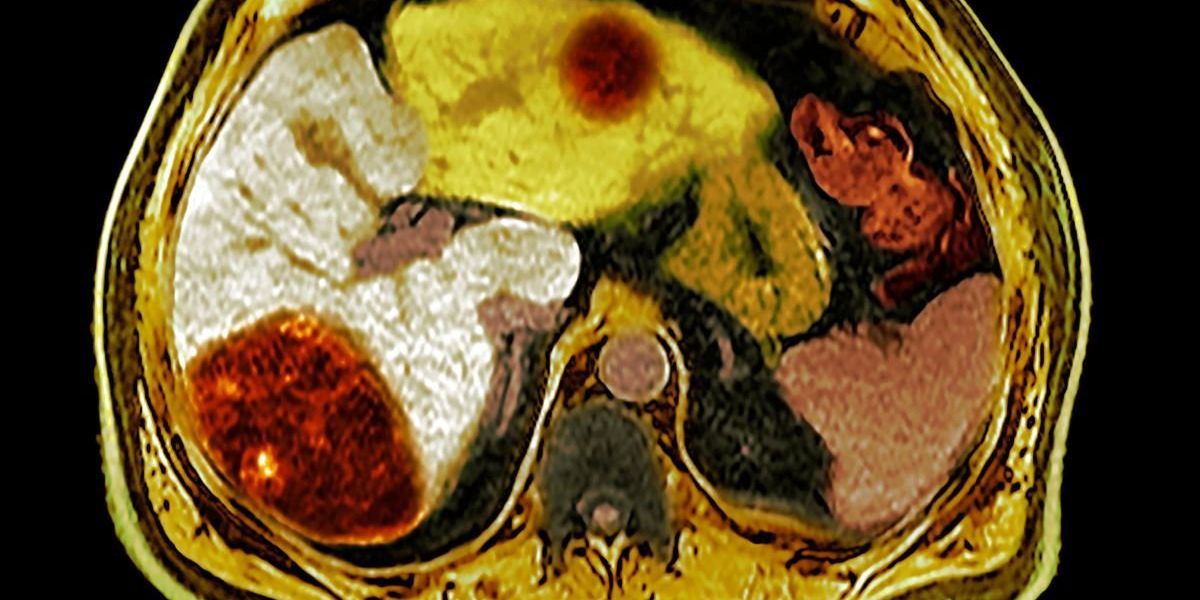 Liver disease: ‘I kept waking up at the same time every night Liver disease: ‘I kept waking up at the same time every night