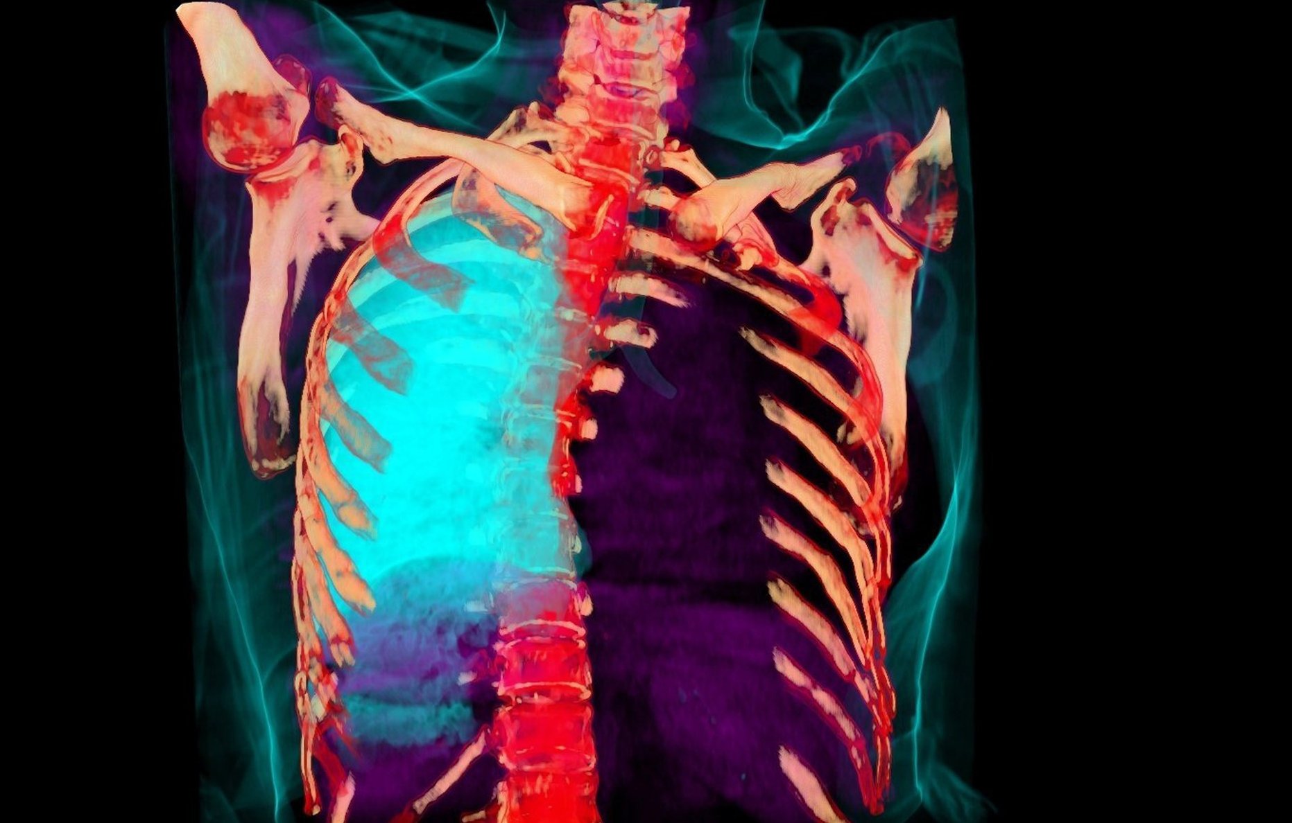 LUNG CANCER 3-D IMAGING