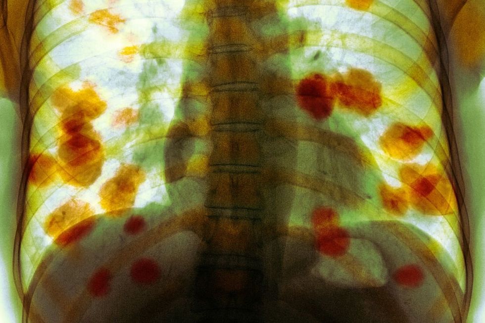 LUNG CANCER SCAN