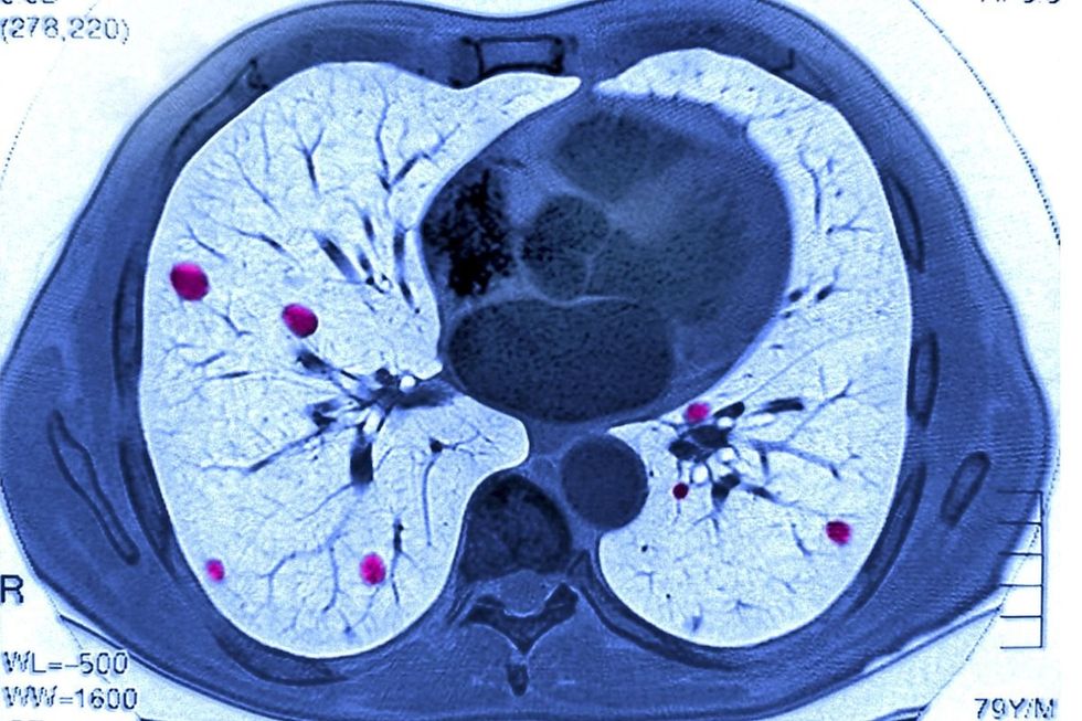 LUNG CANCER