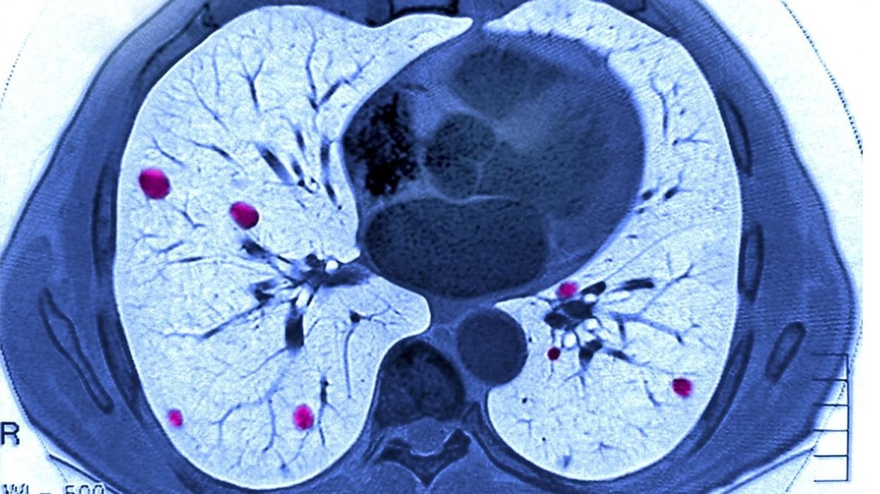 LUNG CANCER
