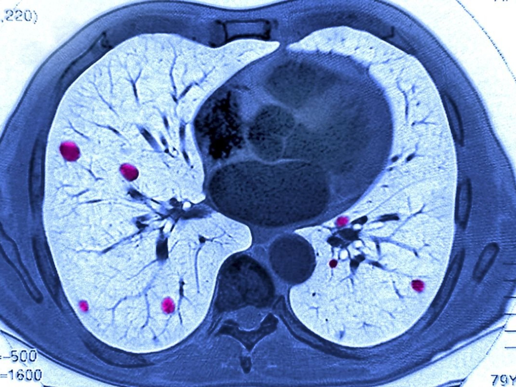 LUNG CANCER