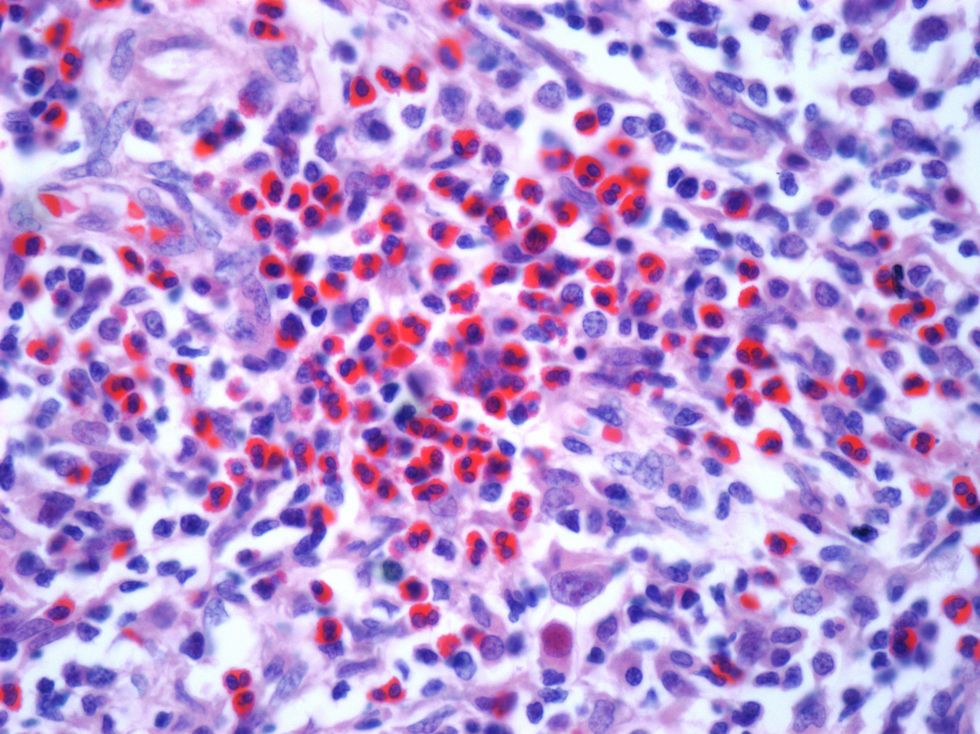 LYMPHOMA CANCER UNDER MICROSCOPE