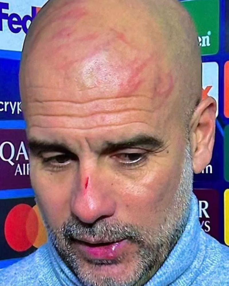Man City boss Pep Guardiola explains injury to his face after dramatic  Feyenoord Champions League draw