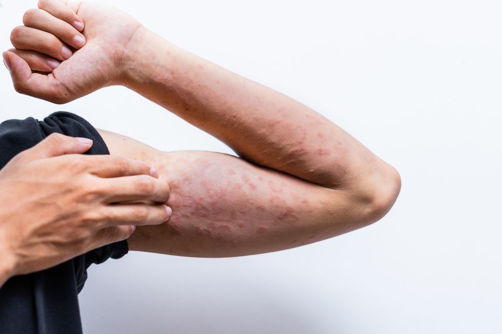 MAN MEASLES RASH