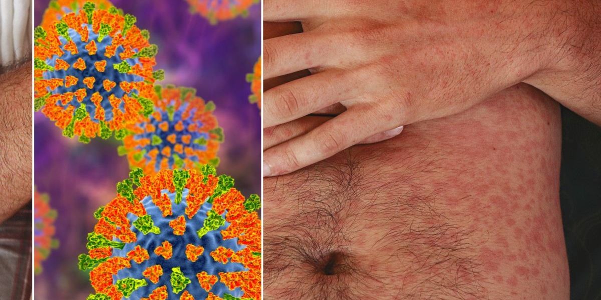 NextImg:Stark warning as 'deadly' disease spreads across UK - worst-hit areas and symptoms to spot