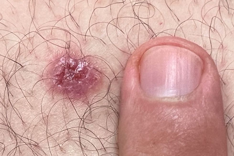 man pointing out sore on skin