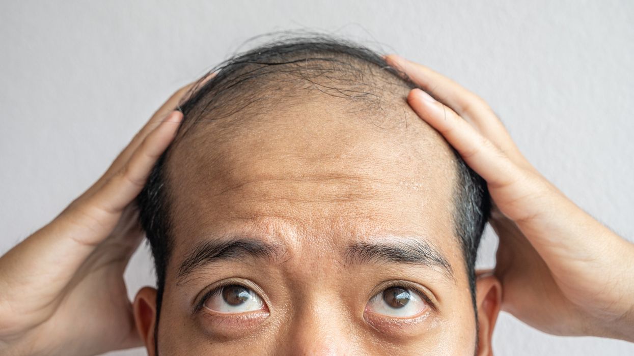 Man struggling with hair loss