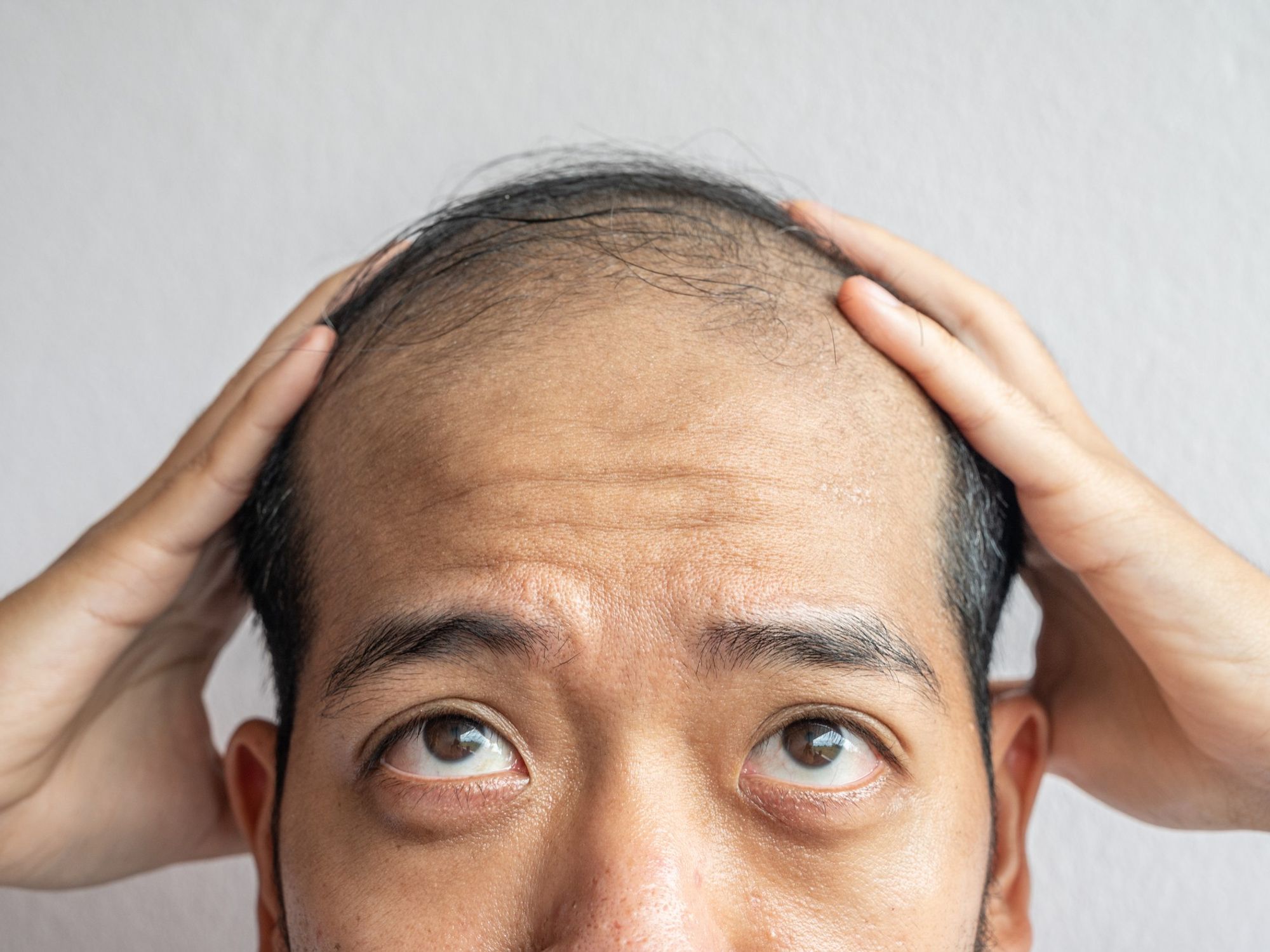 Man struggling with hair loss