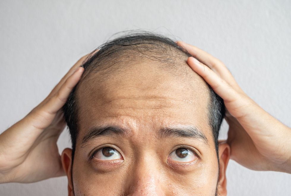 Man struggling with hair loss