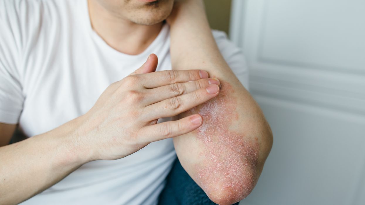 Man with rash