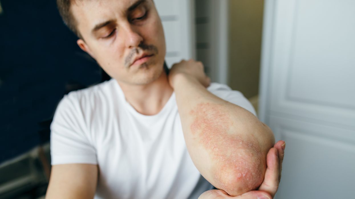 Man with rashes