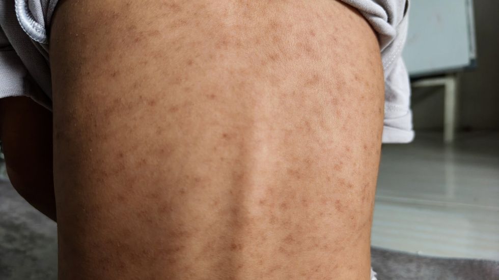 Measles patient