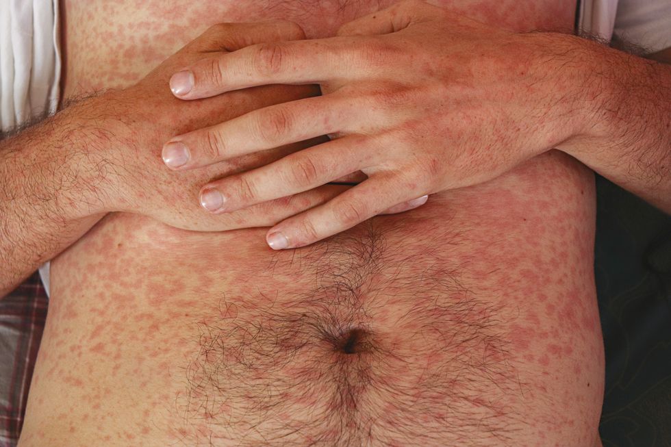 Measles rash across a man's stomach