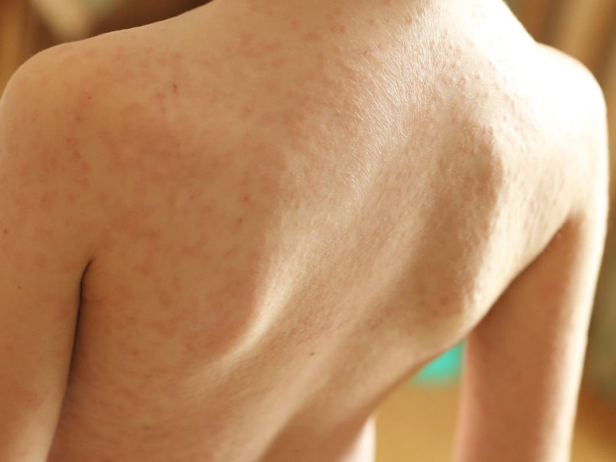 MEASLES RASH ON CHILD