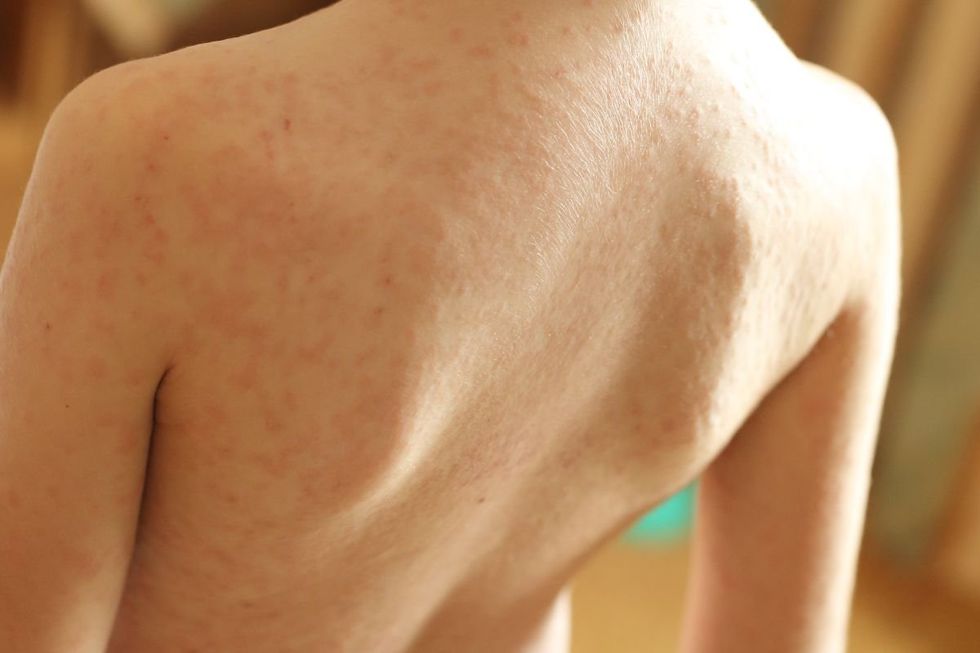 MEASLES RASH ON CHILD