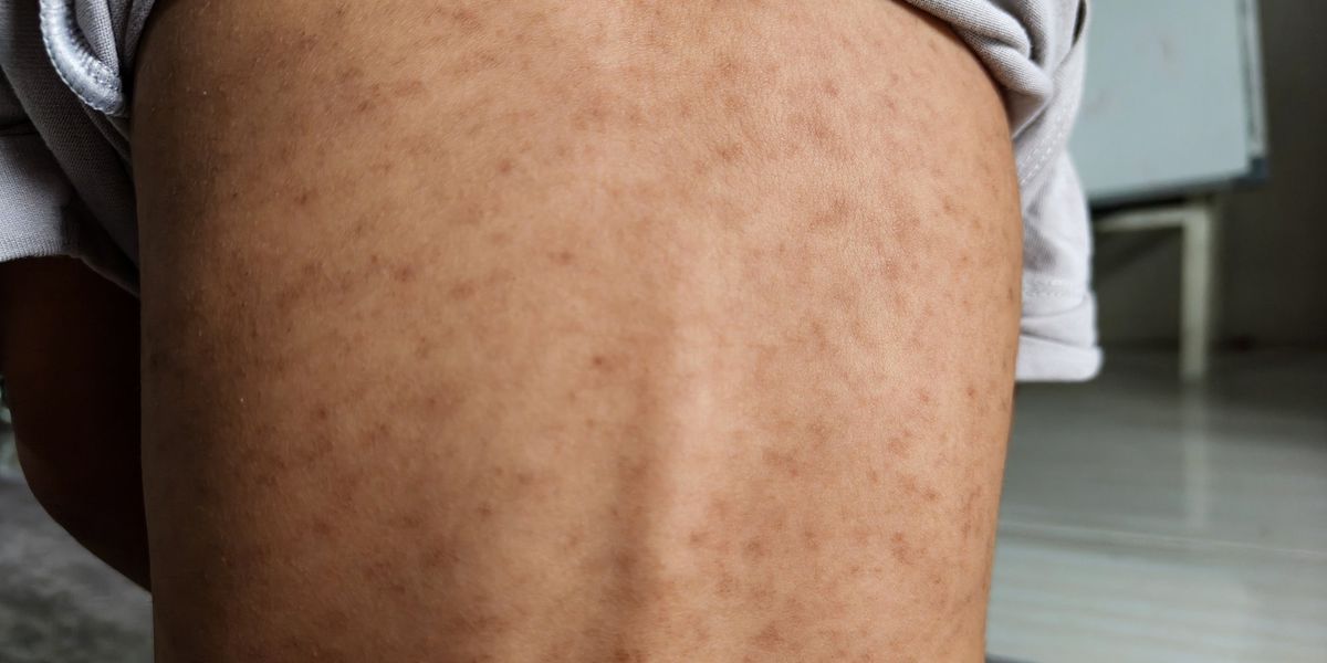 ‘Fast-spreading’ disease leaves more than 60 children infected in London ‘Fast-spreading’ disease leaves more than 60 children infected in London