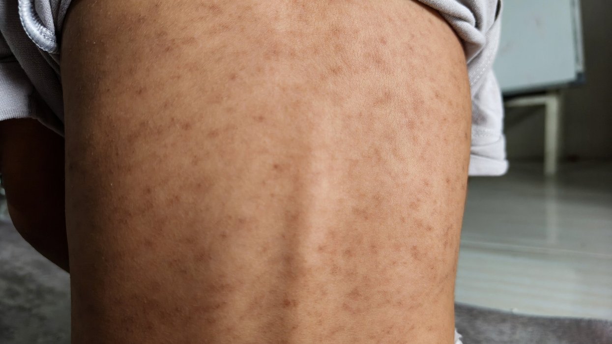 'Fast-spreading' measles outbreak leaves more than 60 children infected in London