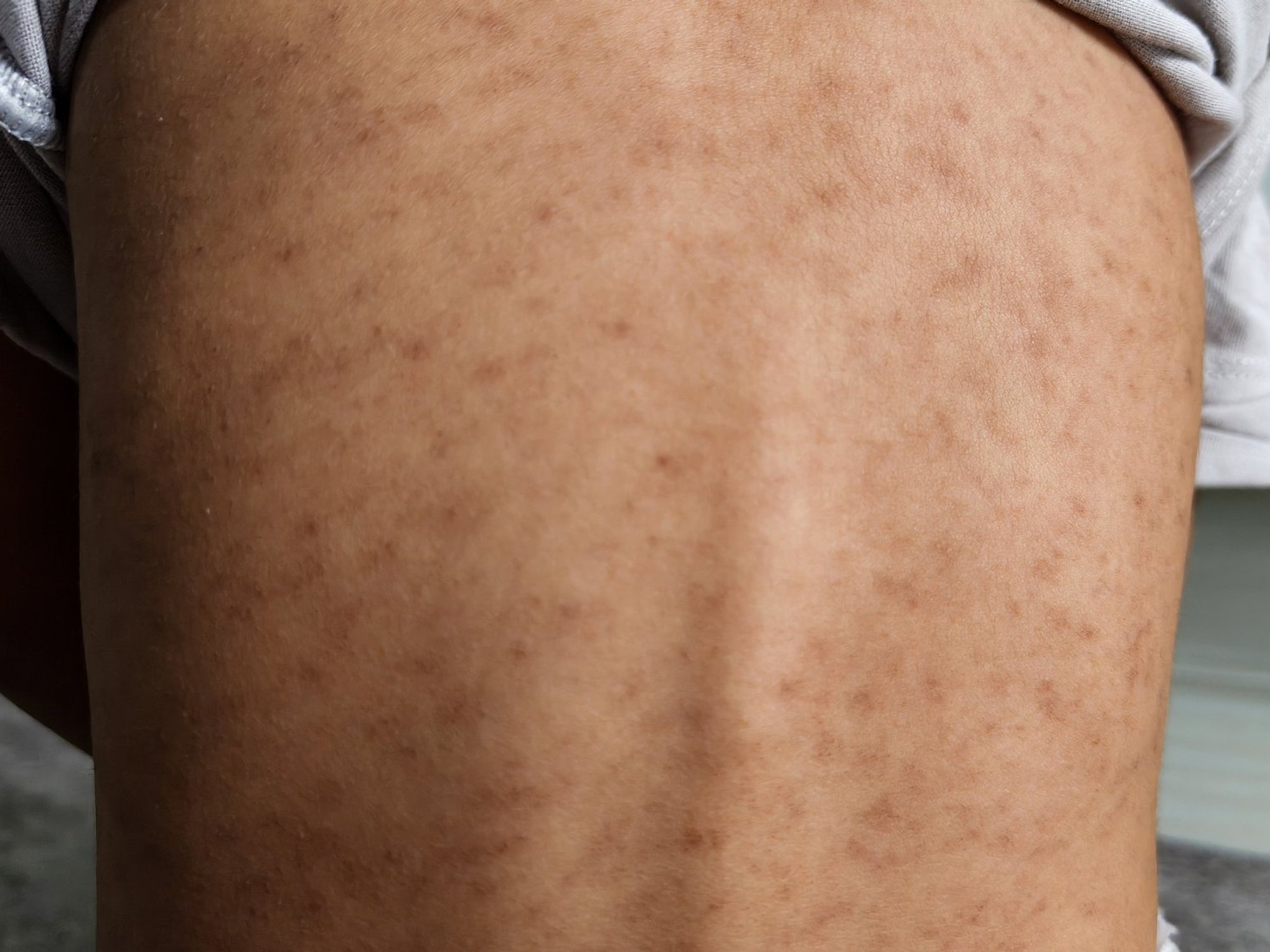 'Fast-spreading' measles outbreak leaves more than 60 children infected in London