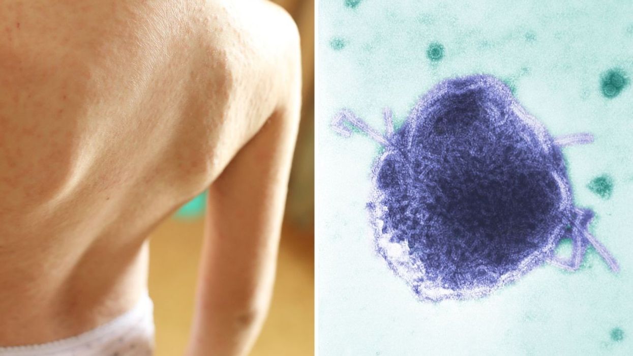 Measles rash stock image and microscope shot