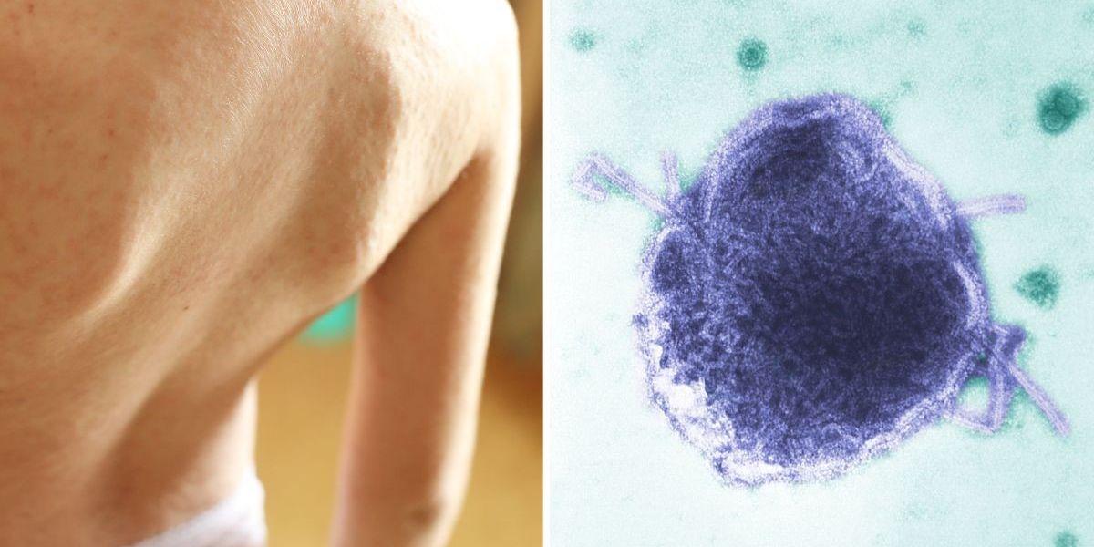 NextImg:Child dies of measles amid fears 'highly contagious illness' could spread 'like wildfire'
