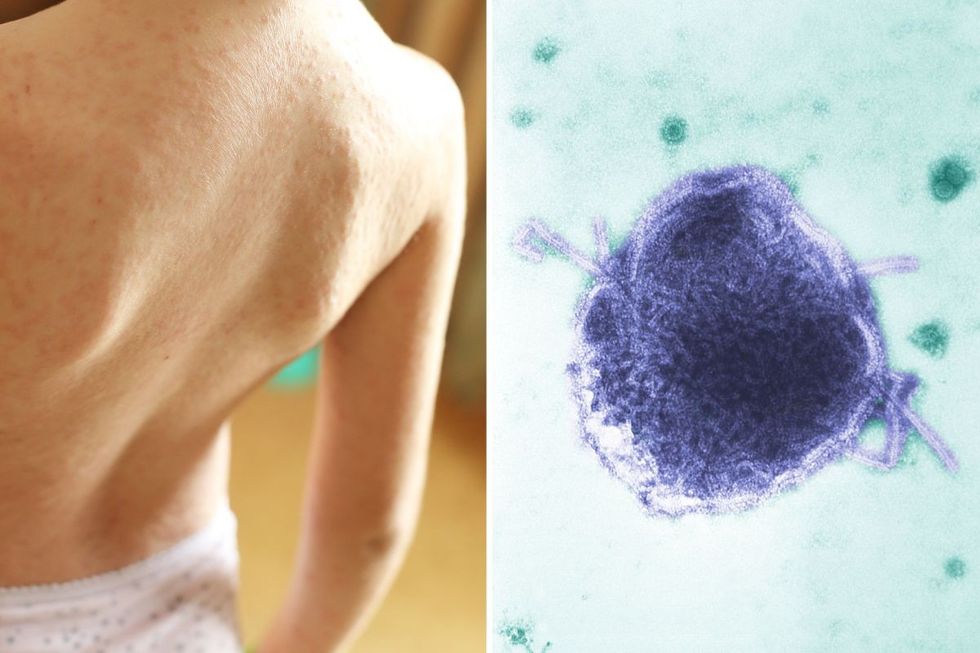 Measles rash stock image and microscope shot