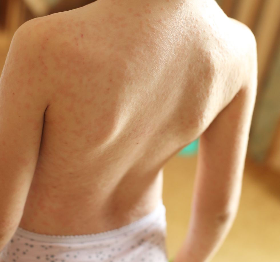 MEASLES RASH STOCK