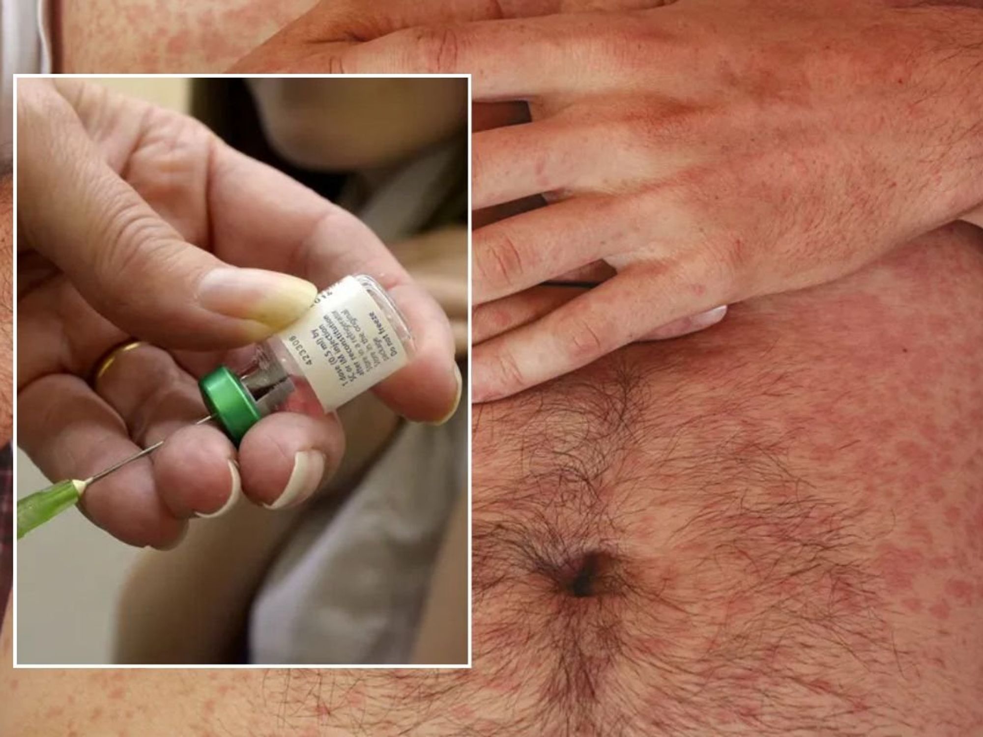 MEASLES RASH
