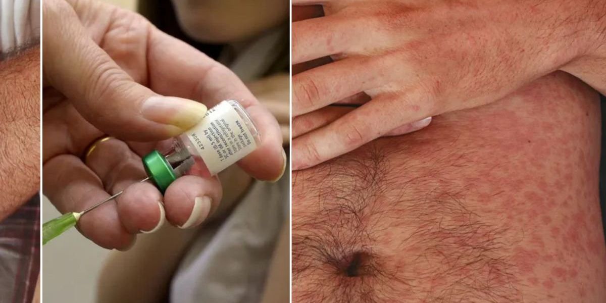 NextImg:Britons alerted to 'highly contagious virus' that causes 'serious complications' - early symptoms may start in the eyes