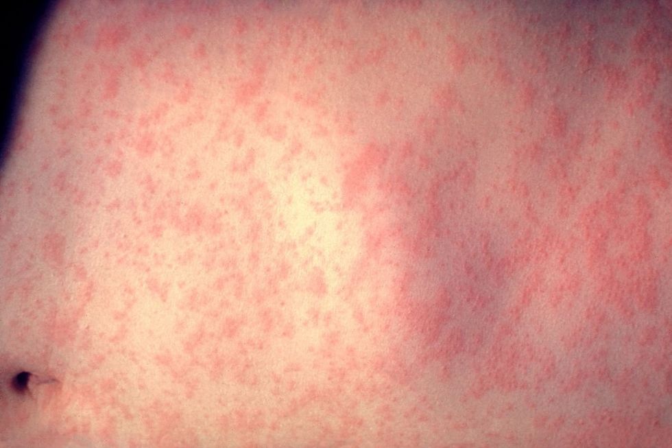 measles rash