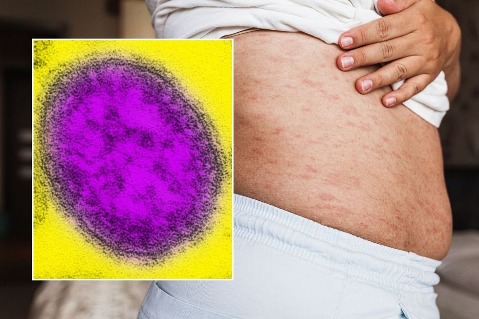 measles symptoms and virus