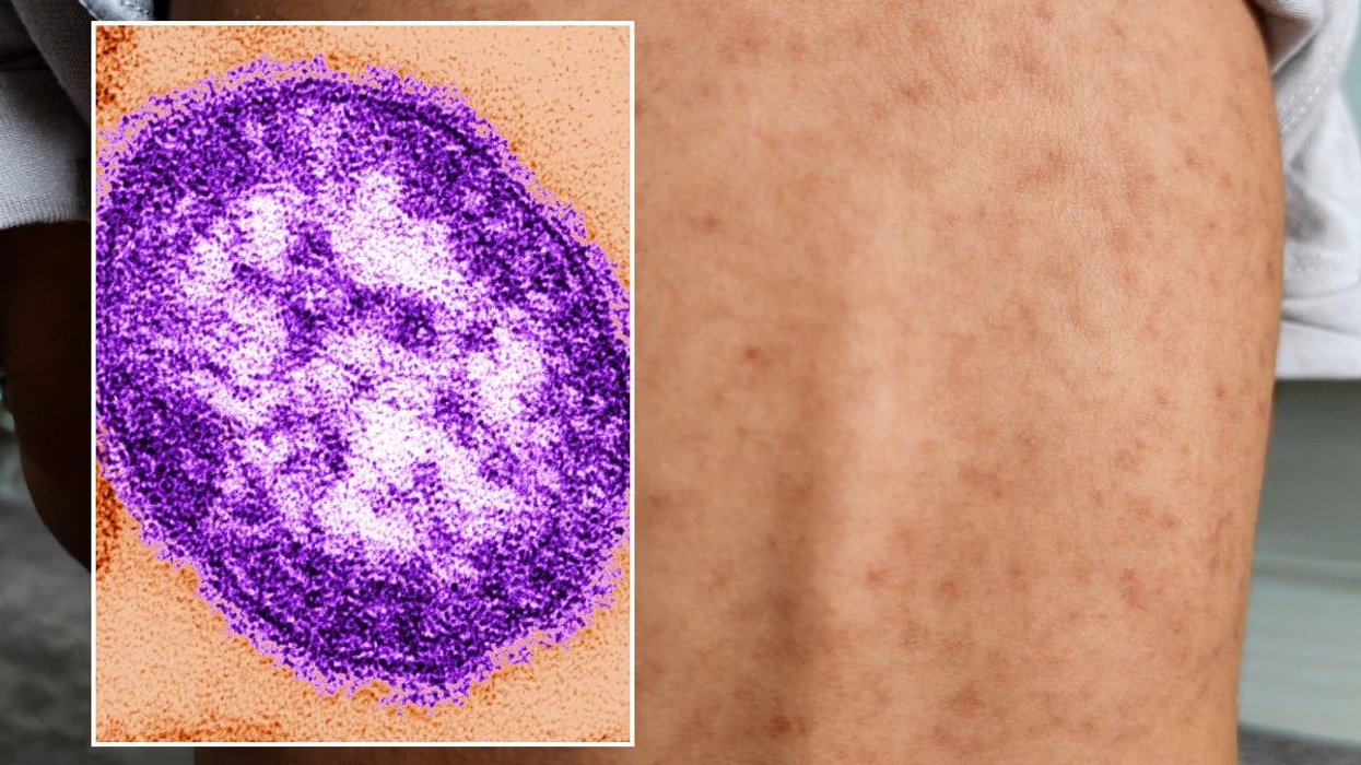 measles under microscope