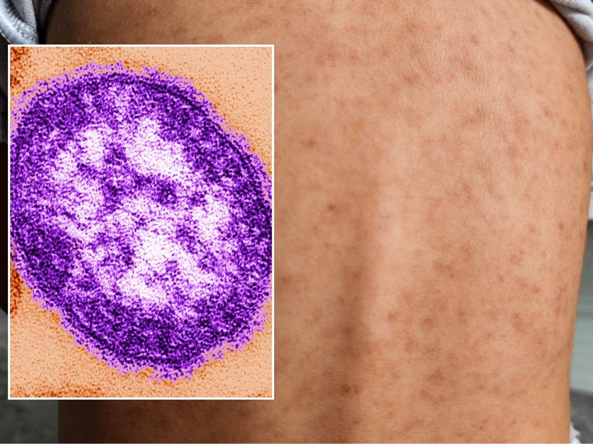 measles under microscope