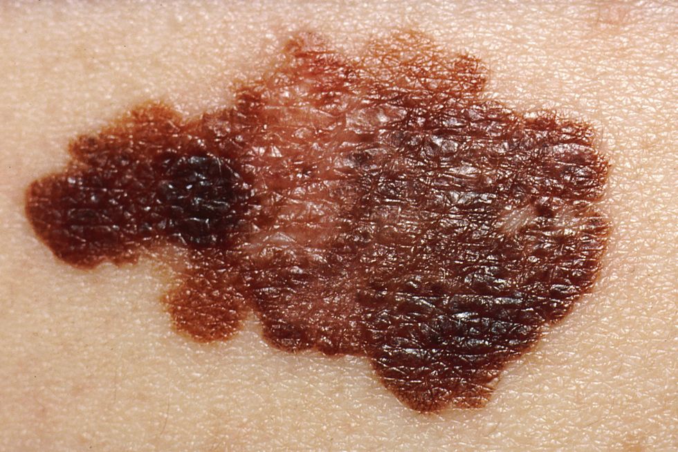 Melanoma stock image